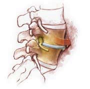 bone growth stimulators unstable lumbar spine back pain nerve damage orthofix